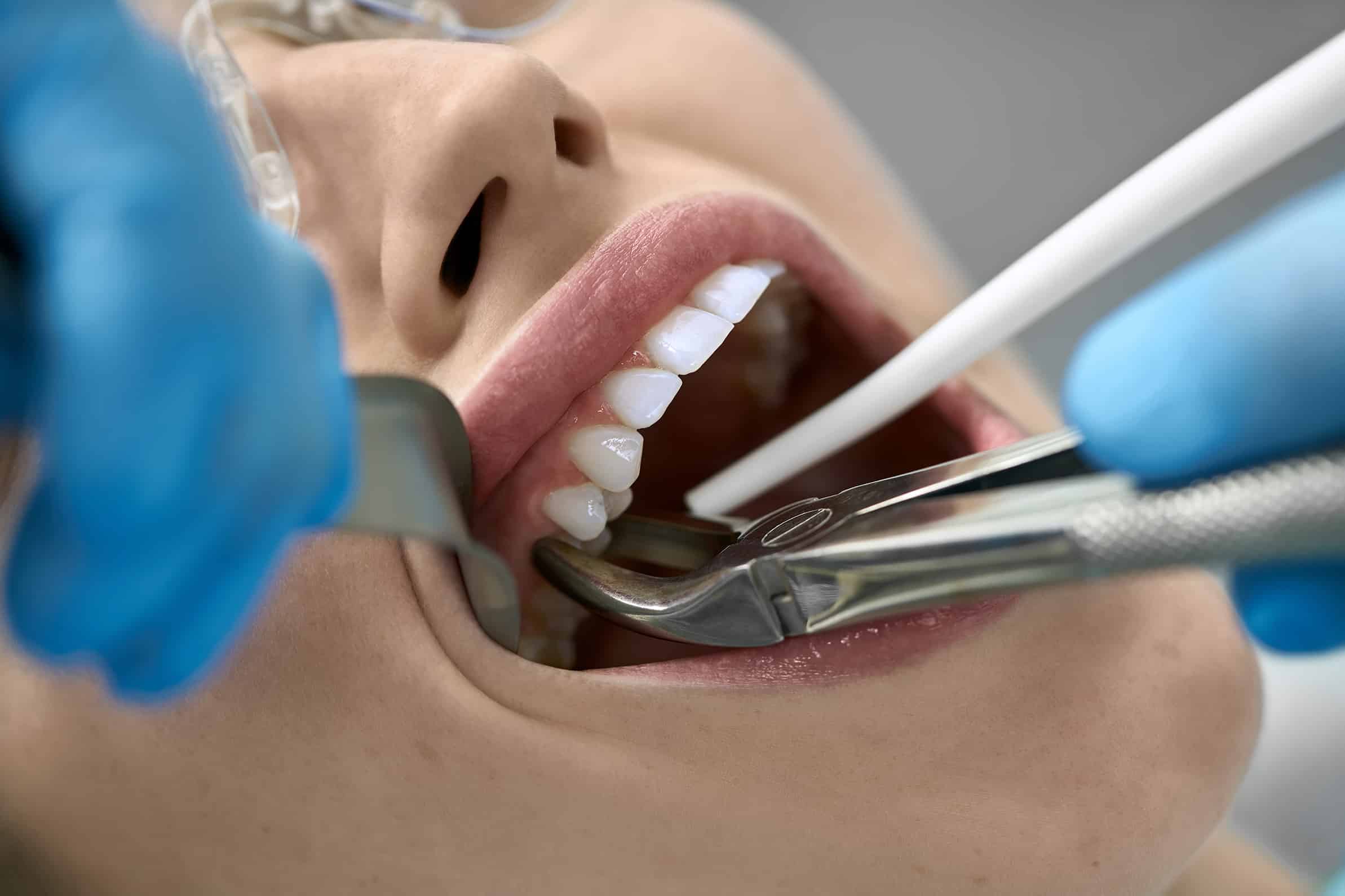 tooth extraction The Dentist in Louisville in Louisville, CO